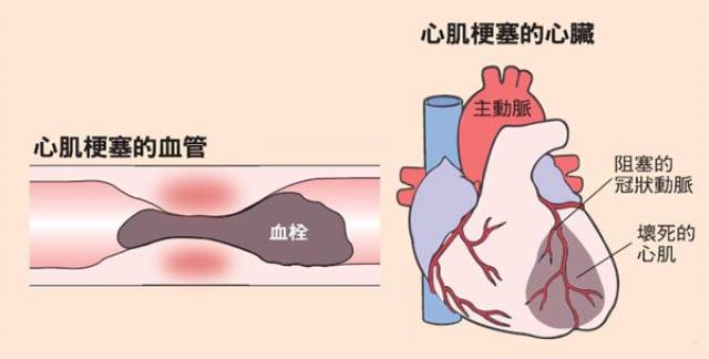 急性心肌梗死死亡率那么高,我们到底应该怎么做?