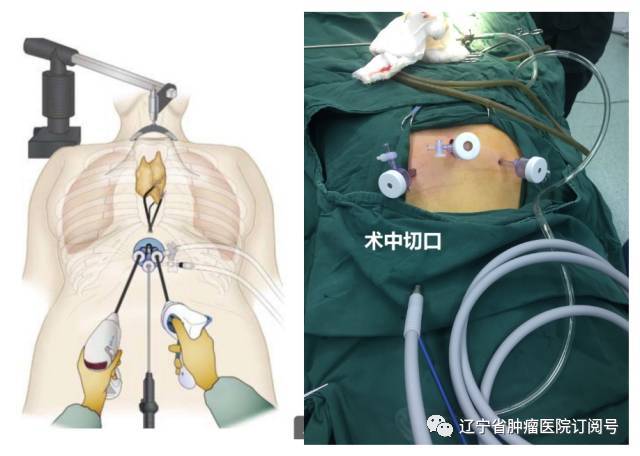 我院胸外科成功完成了院内首例经剑突下切口单腔气管插管辅助人工气胸