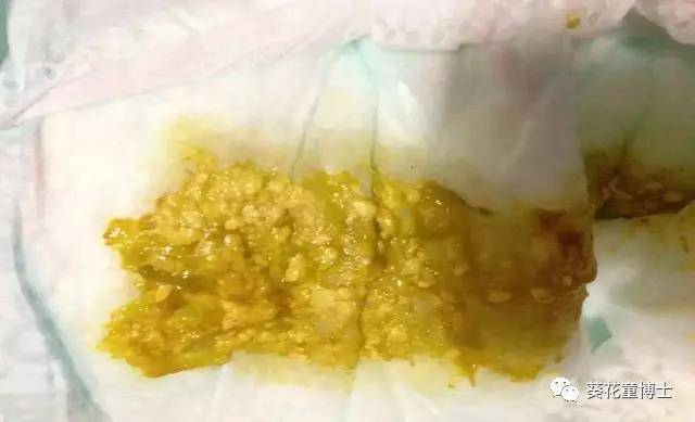 奶瓣,绿便,腹泻,便秘.宝宝的各种便便真图全解!