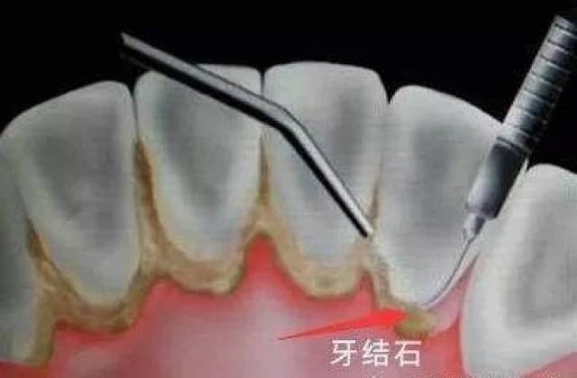 什么方法可以去除牙结石 69d43c4b657643e69074a889b9b513bf.jpeg