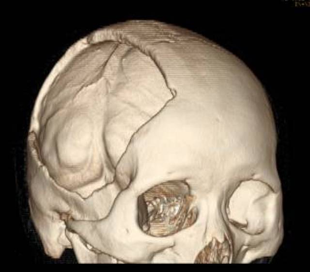 该技术先通过ct扫描患者的颅骨,经过三维重建塑型制造出和颅骨缺损区
