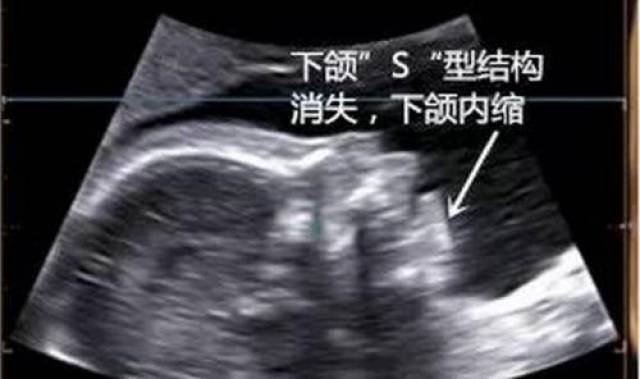 怀孕22周,产检被查出"鸟面宝宝"!千万别错过3次筛查胎儿畸形机会