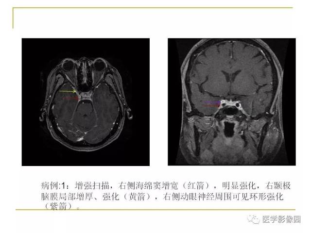 痛性眼肌麻痹综合征(tolosa-hunt综合征)临床及影像丨