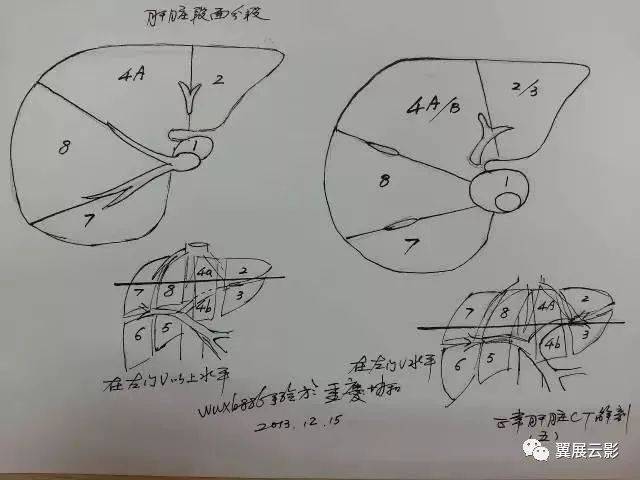 读懂肝脏ct片原来这么简单