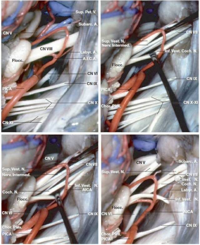 桥小脑角脑膜瘤手术策略与技巧 | the neurosurgical