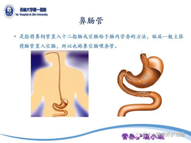 鼻肠管的留置及位置判定方法