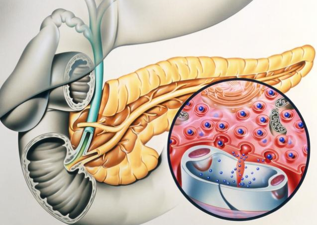 暴饮暴食后忽然腹痛 胰腺发起脾气来或致"命悬胰腺"
