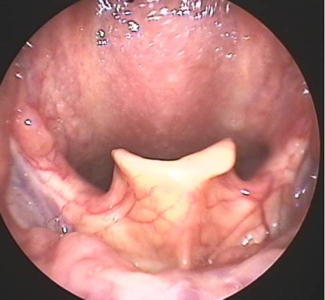 喉镜下 会厌是喉的软骨之一,呈叶片状,上缘游离呈弧形,它处在气管与
