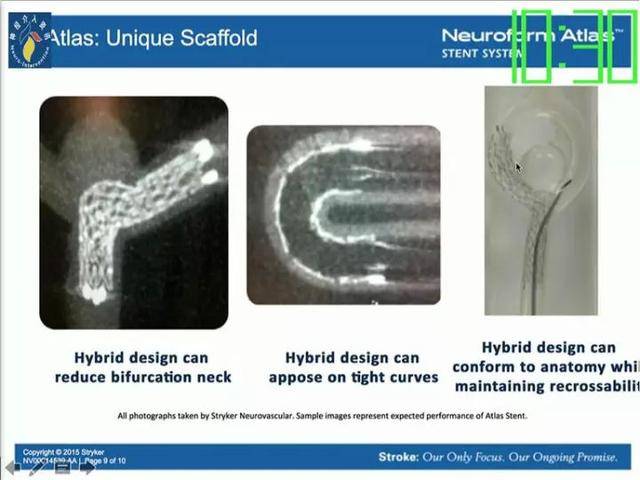 neuroform atlas支架治疗颅内动脉瘤