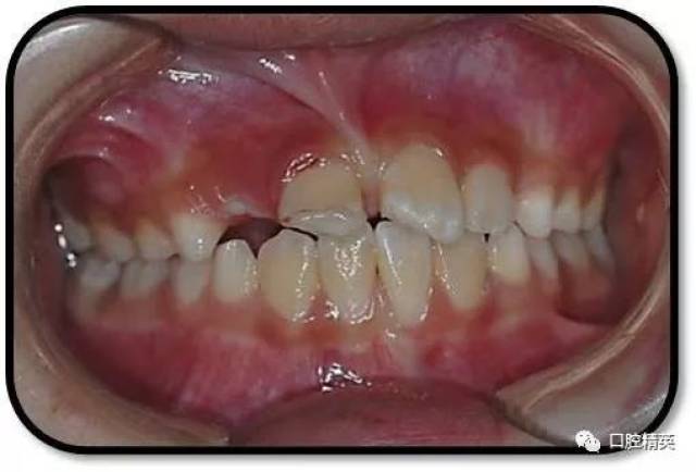 8岁儿童前牙外伤冠折断冠再接