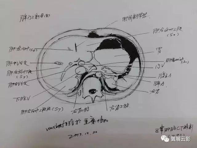 读懂肝脏ct片原来这么简单