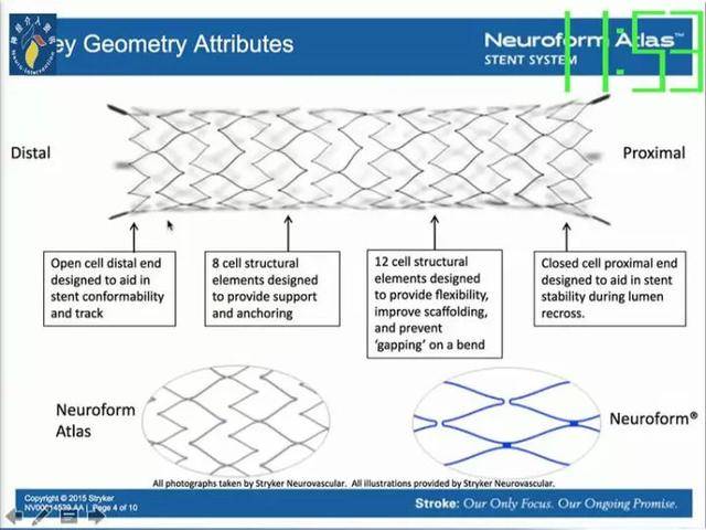 neuroformatlas支架治疗颅内动脉瘤