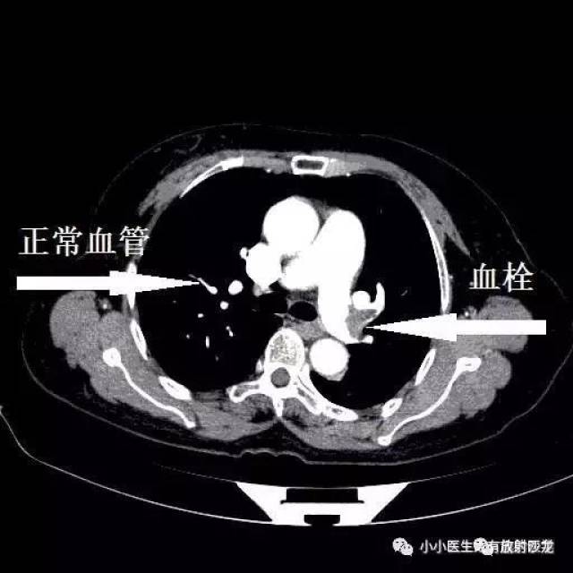 肺栓塞ct轻松入门:我整理的经典图谱,学不会我拜你为师