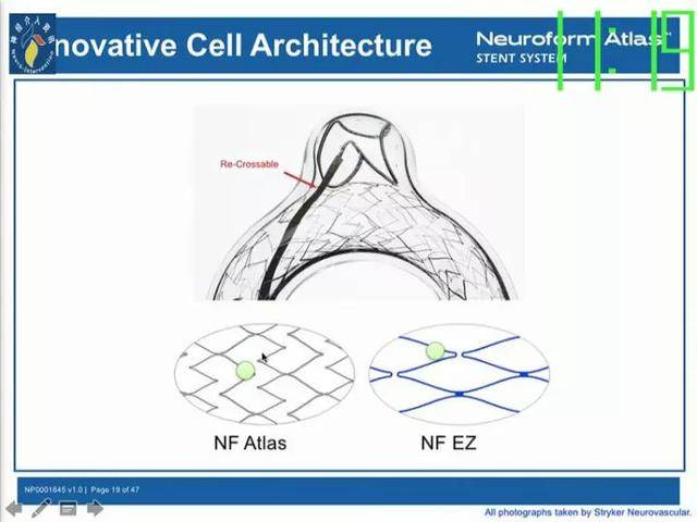 neuroformatlas支架治疗颅内动脉瘤