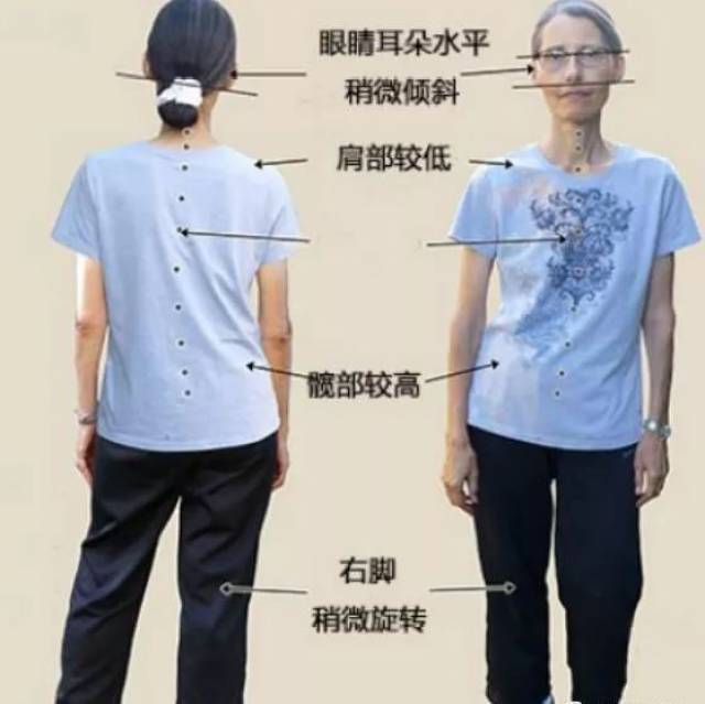 高低肩 许多惯用右手的人往往会有以下轻微的不对称现象:右肩肩胛骨