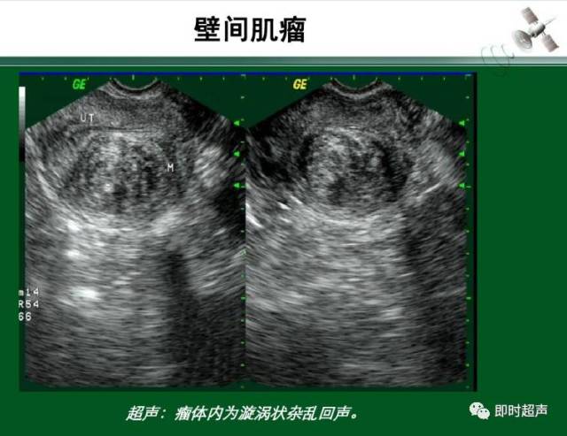 子宫肌瘤的超声诊断与鉴别