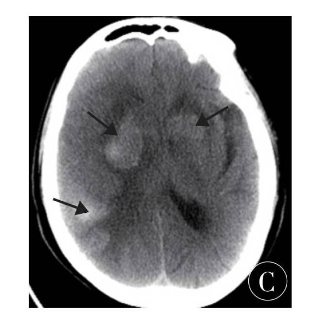 ①右侧大脑半球及左侧尾状核出血肿密度较前减低,边缘模糊; ②中线