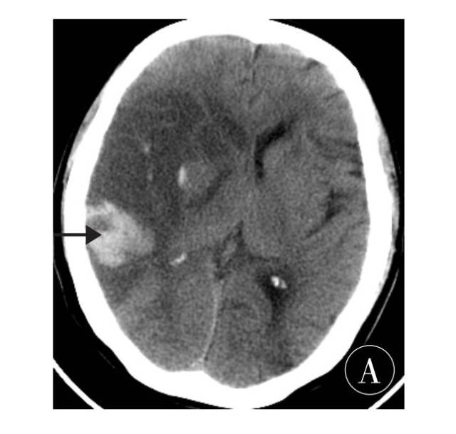 再次急查头颅  ct 示 : ①右侧大脑半球梗死伴出血; ②左侧尾状核出血