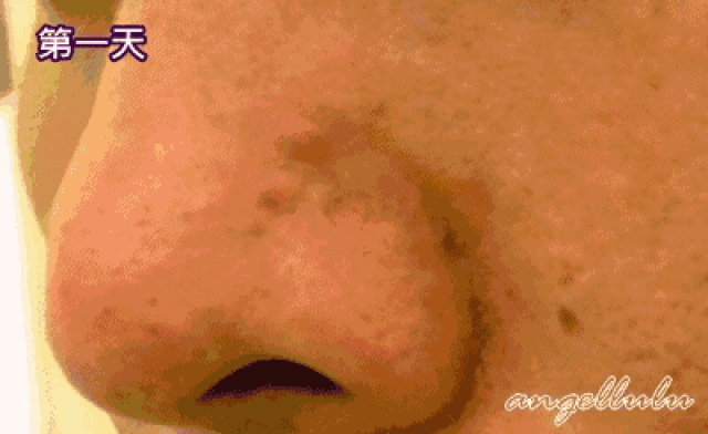 除了挤之外,应该如何对待我的痘痘?