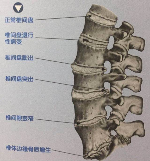 椎节失稳,松动;髓核突出或脱出;骨刺形成;韧带肥厚和继发的椎管狭窄等