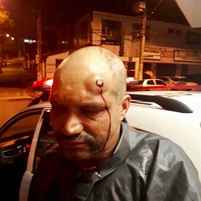 巴西男子遭抢劫并被枪击 然而子弹却被卡在了头部