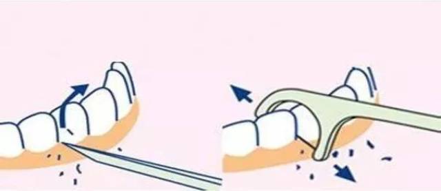 科普| 刷牙能代替洗牙吗?
