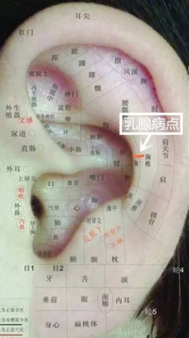 针灸:中医外科治疗乳腺增生的秘密武器