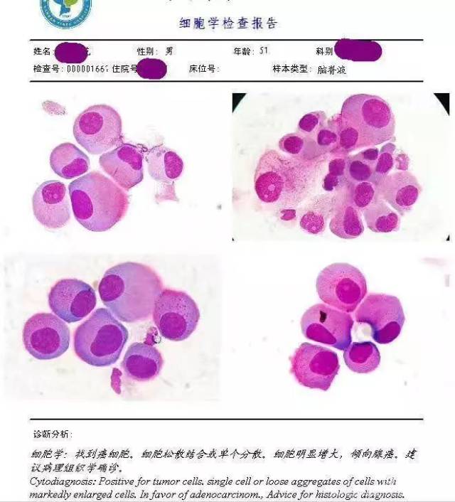 胸腹水细胞图文报告