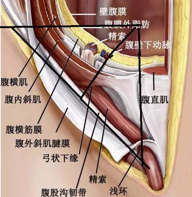 真性腹外疝的疝内容物必须位于由壁腹膜所组成的疝囊内,借此可与内脏
