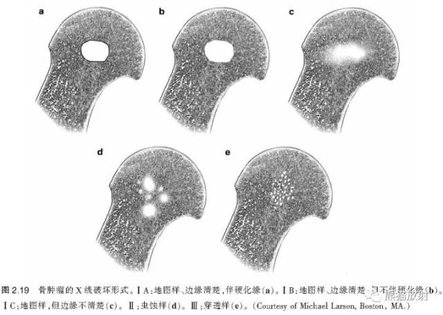 如何评估骨病变?—骨破坏的形式和病变的边缘