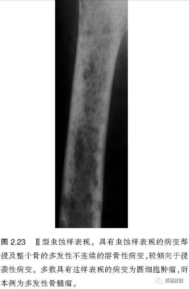穿透样骨破坏:穿透了骨质而因此几乎不能在x线片上显现的溶骨(但在