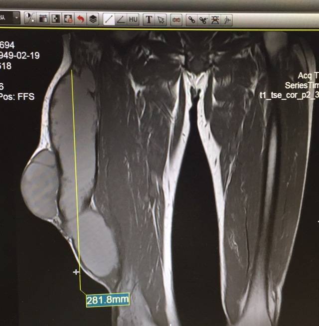 经过 彩超和mri(磁共振)的局部检查,初步确定其为 表皮样囊肿.