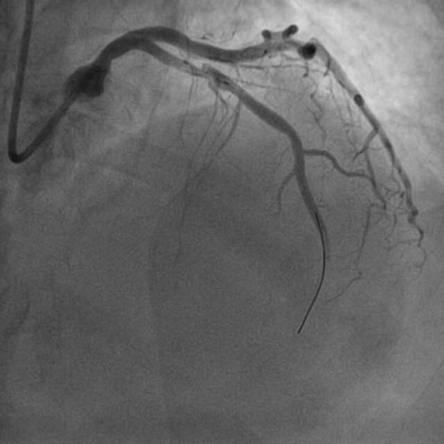 案例分析|心脏超声造影在急性心梗围手术期的应用
