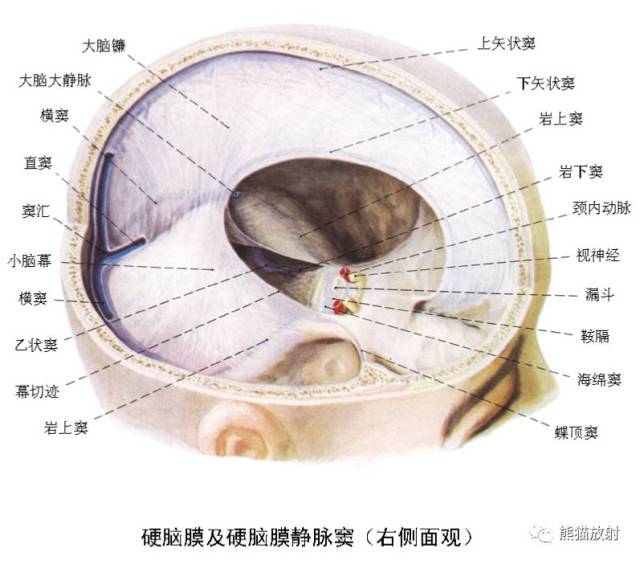 (1)贯穿大脑镰全程的边缘清晰的高密度带,出血量少时大脑镰显得增宽