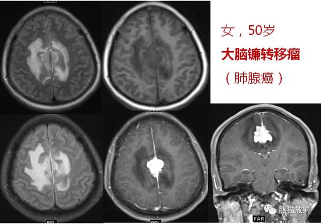 (1)贯穿大脑镰全程的边缘清晰的高密度带,出血量少时大脑镰显得增宽