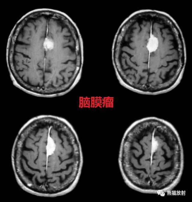 (1)贯穿大脑镰全程的边缘清晰的高密度带,出血量少时大脑镰显得增宽