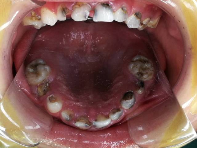 【宝妈提醒】1岁7个月宝宝牙齿全部烂光 原来是得了这种病!