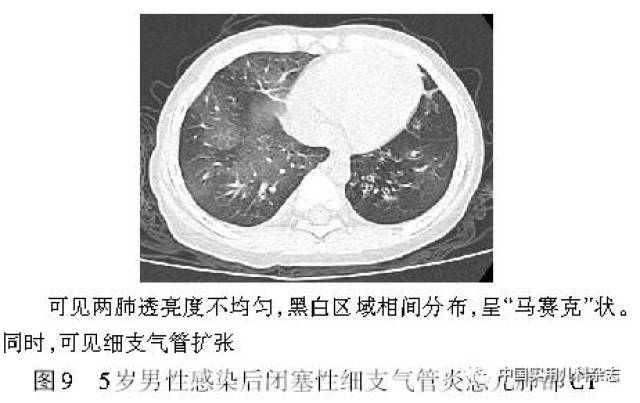 专题笔谈│细支气管炎影像学特征