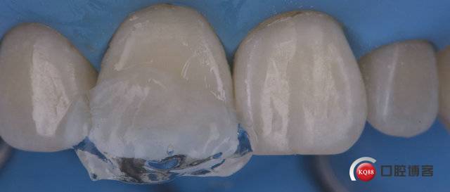 fig.    characterization of the incisal edge is done.