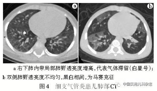 专题笔谈│细支气管炎影像学特征