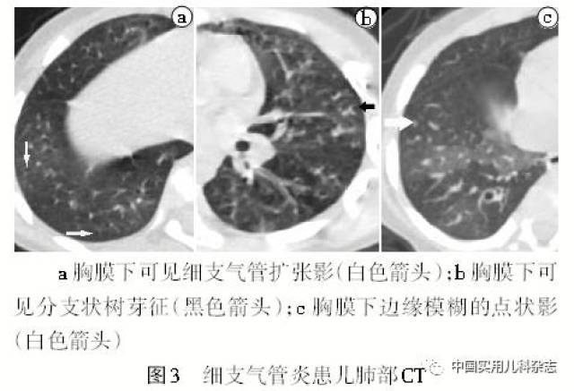 专题笔谈│细支气管炎影像学特征