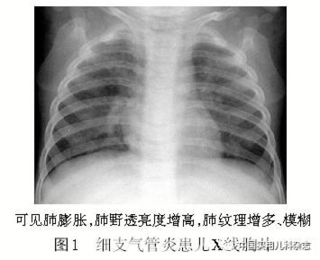 专题笔谈│细支气管炎影像学特征