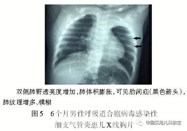 专题笔谈│细支气管炎影像学特征