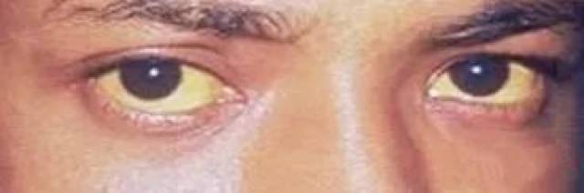 当心!一旦眼睛出现这8种症状,可能是大病征兆
