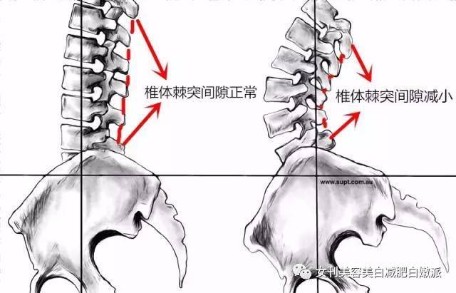 骨盆前倾导致腰椎曲度过大,椎体棘突间隙变小,时间久了慢慢就会 出现