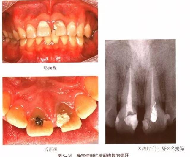 5mm的牙本质称为牙本质肩领. (五)桩核的牙体预备 3.