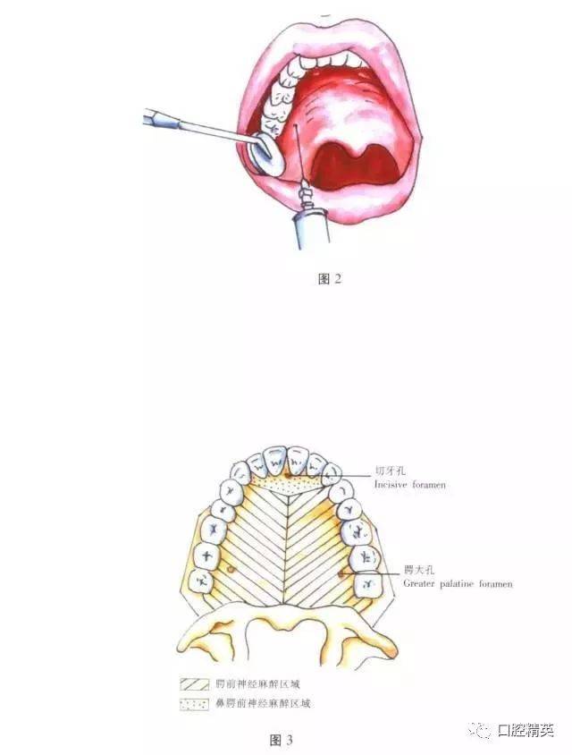 进针点:注射针自对侧口角向患侧腭大孔黏膜表面标志稍前内方为刺入点