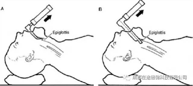 2,操作者站在患者的头部,左手持喉镜.保持视线与病人喉轴线平行.