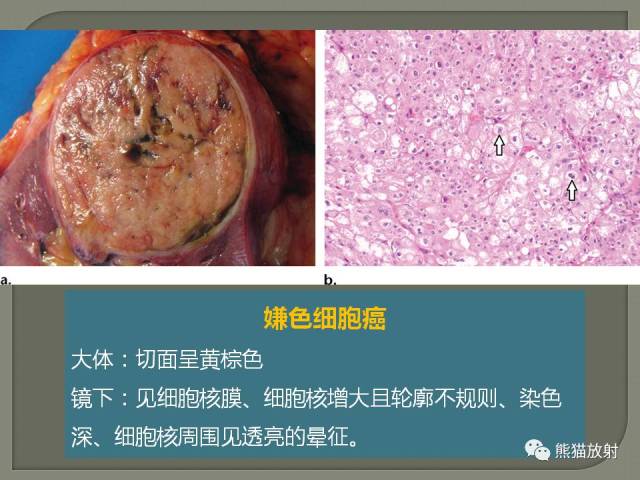 肾嫌色细胞癌 chromophobe rcc