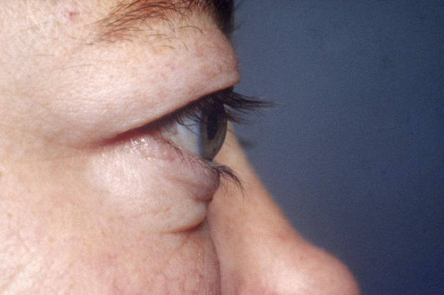 眼球突出是甲状腺相关眼病的一个典型症状.